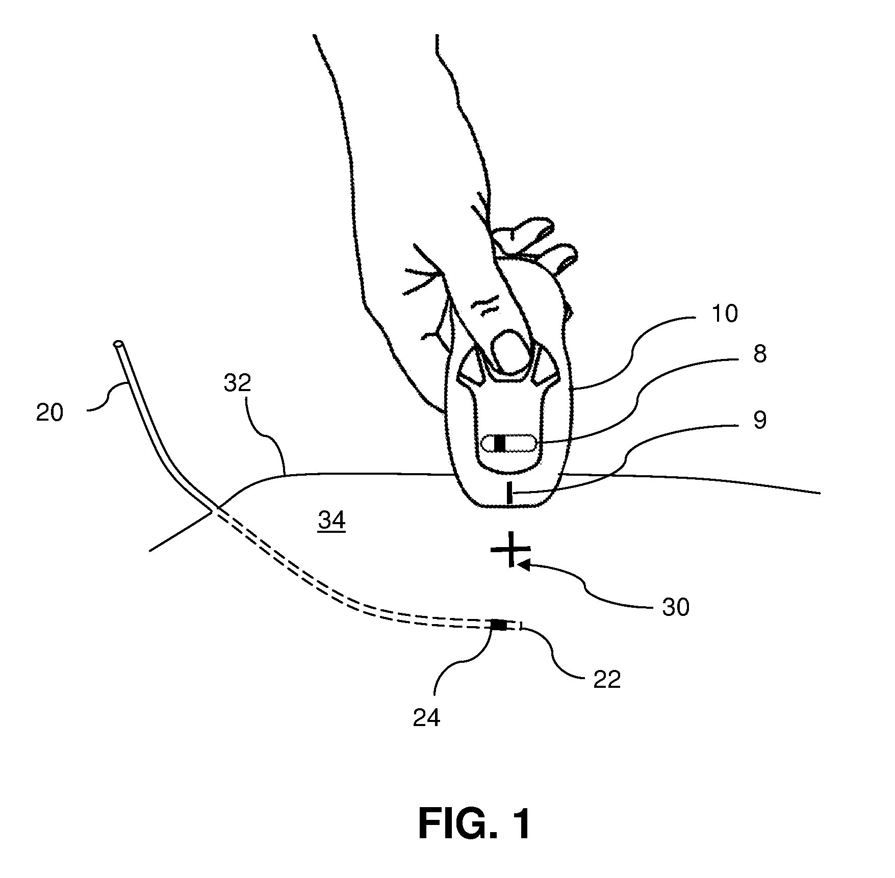 System for optically detecting position of an indwelling catheter