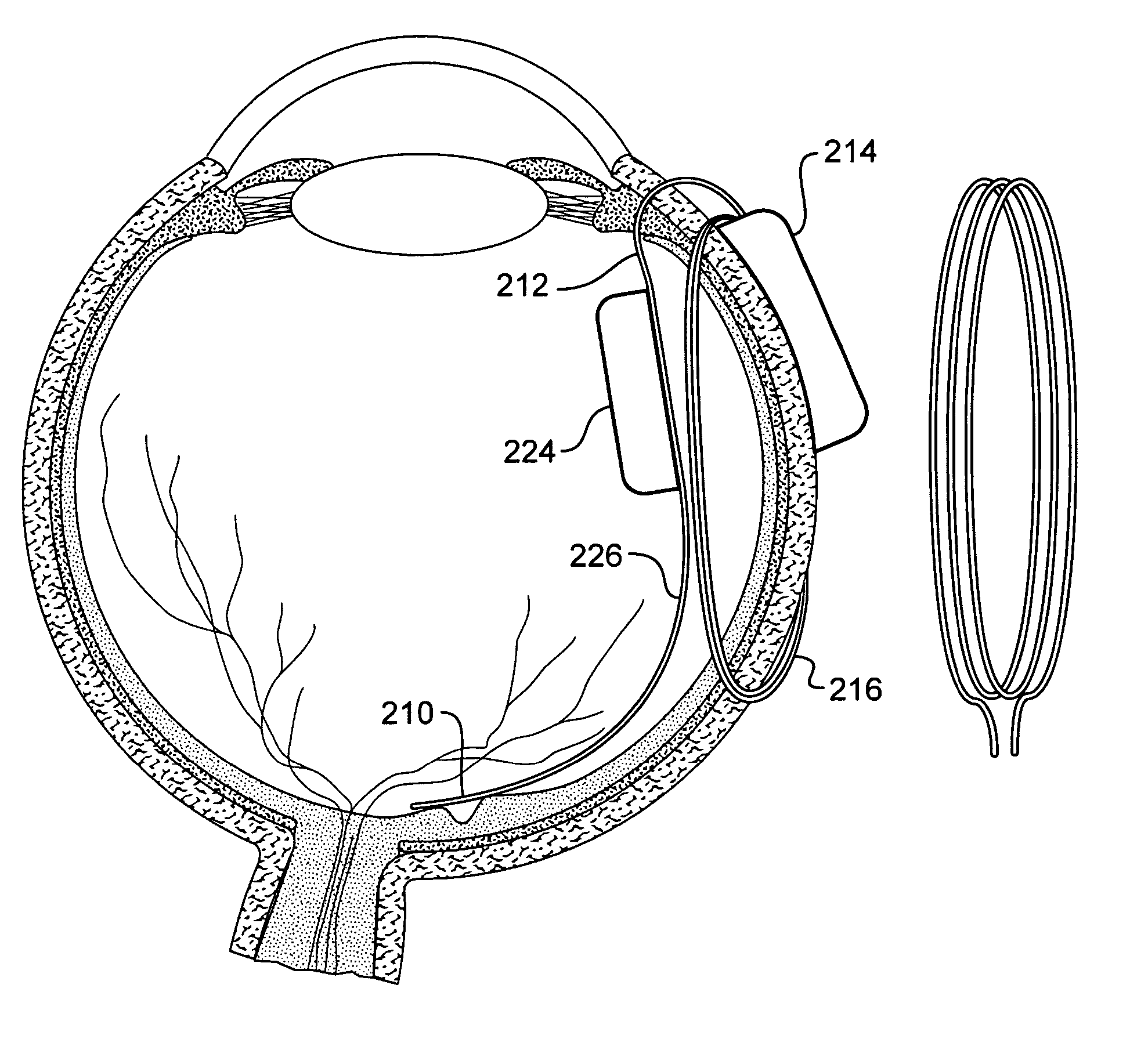 Retinal prosthesis