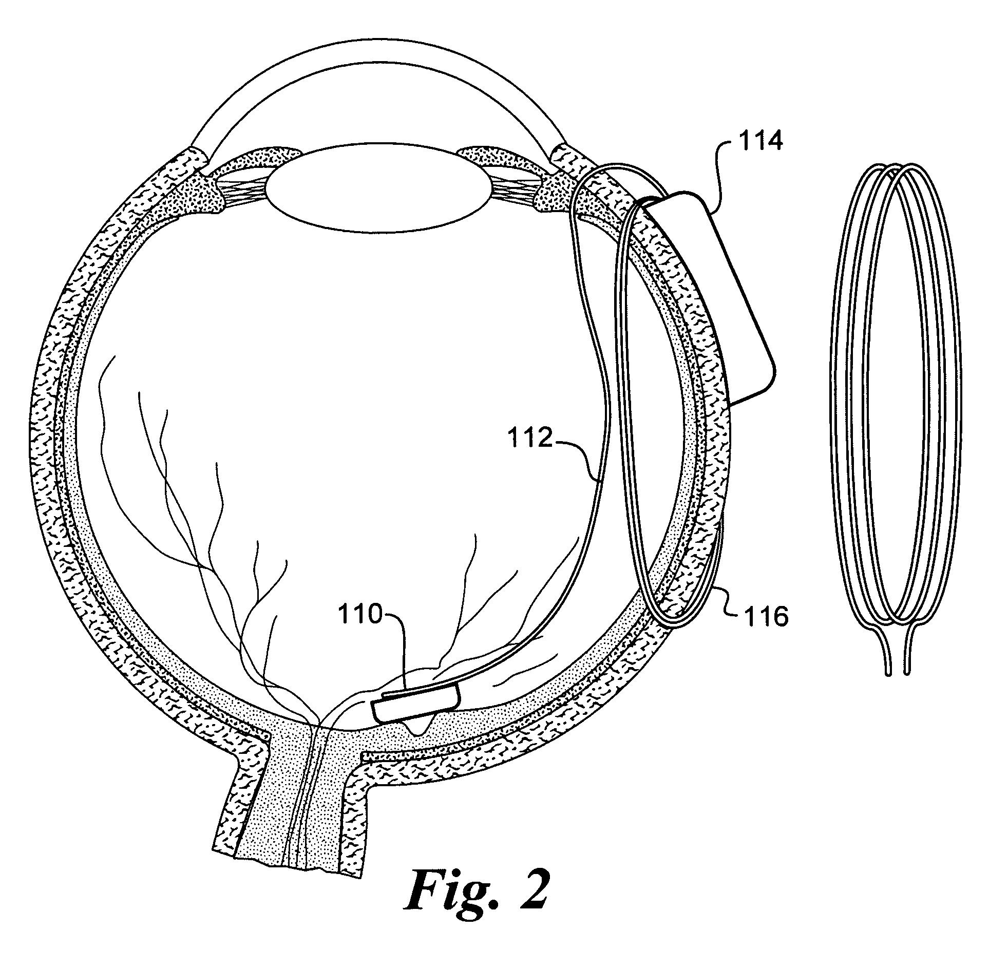 Retinal prosthesis