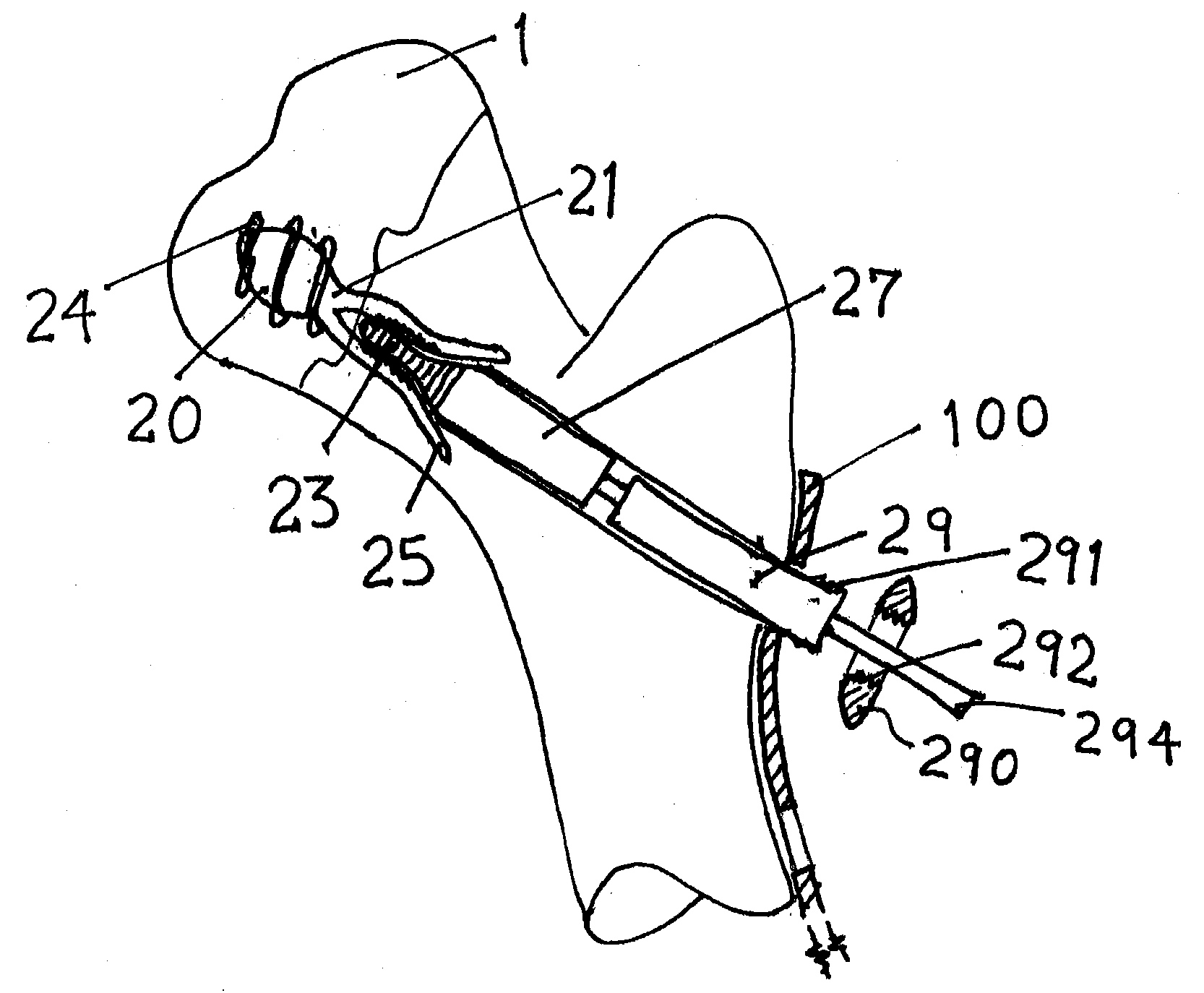 Screw and method of use