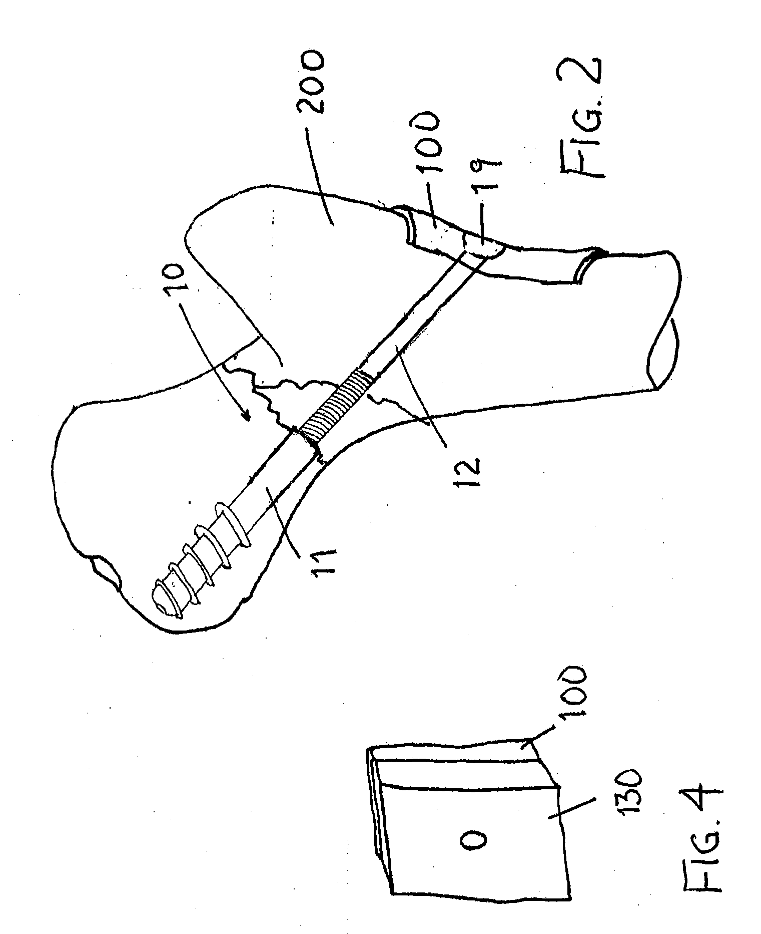 Screw and method of use