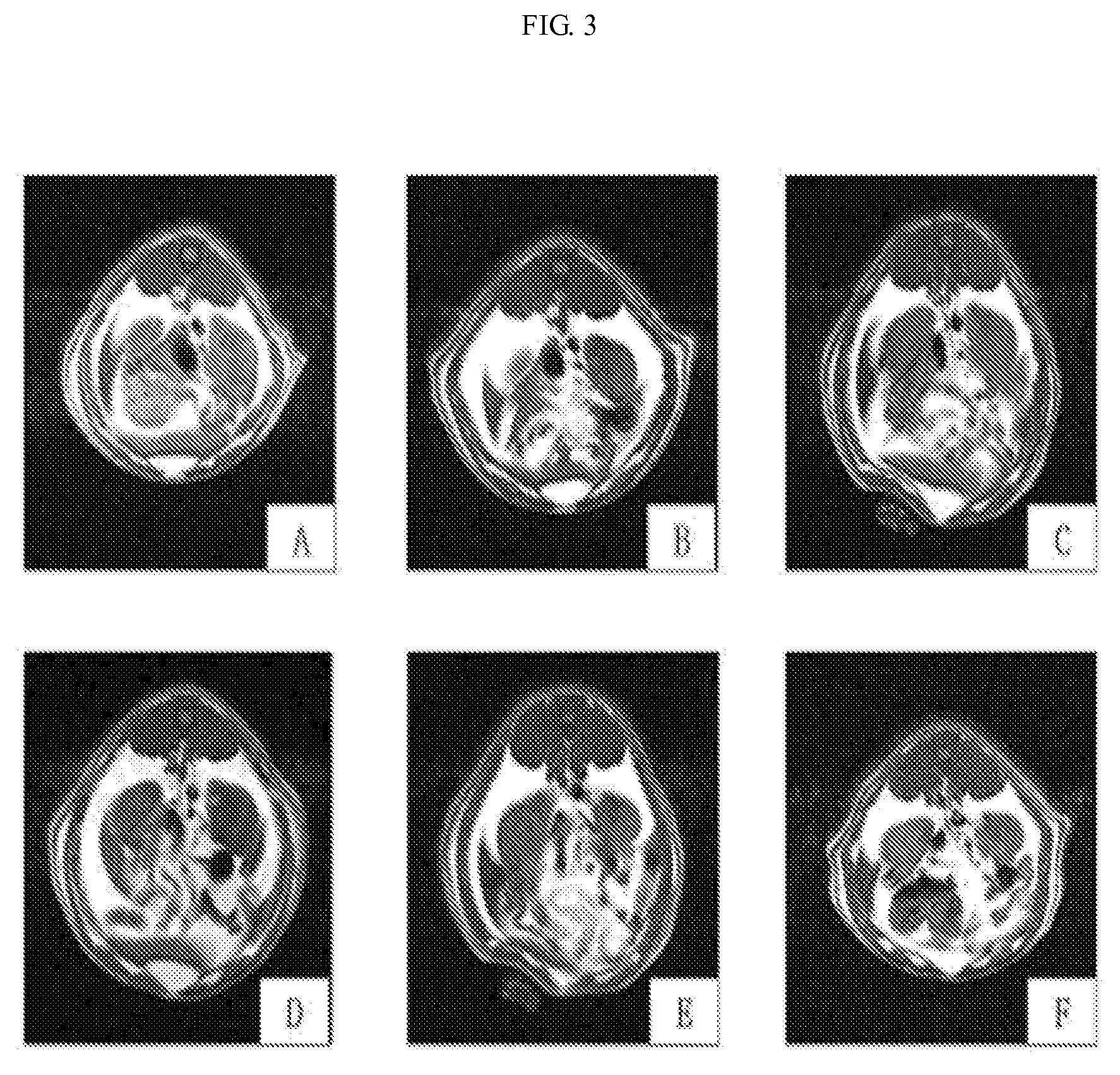 Method For Preparing Extract For The Prevention and Treatment Of Hyperlipidemia and Obesity From the Extract of Aster Spathulifolius Aerial Part and Composition Containing The Same