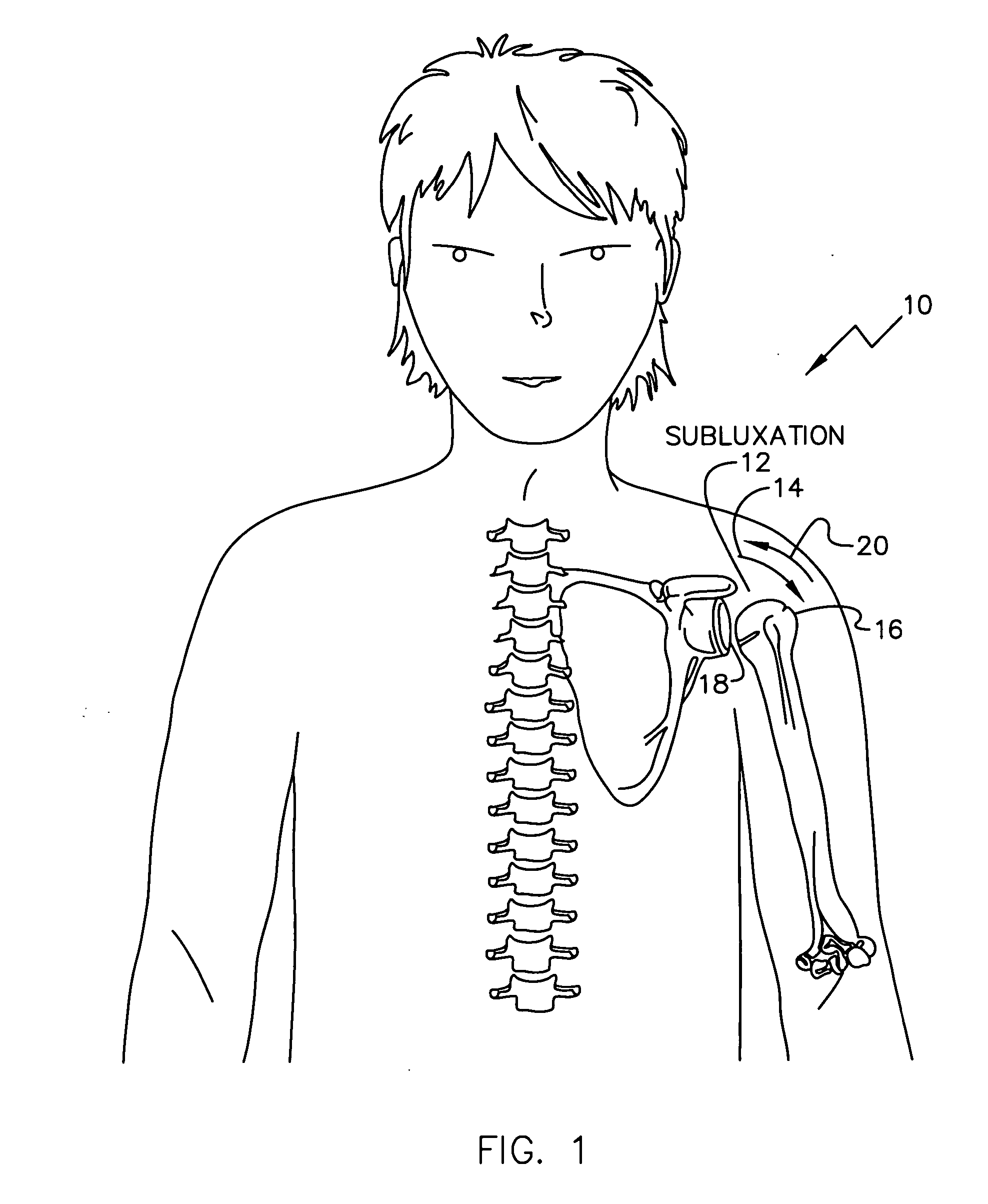 Electrical treatment to treat shoulder subluxation