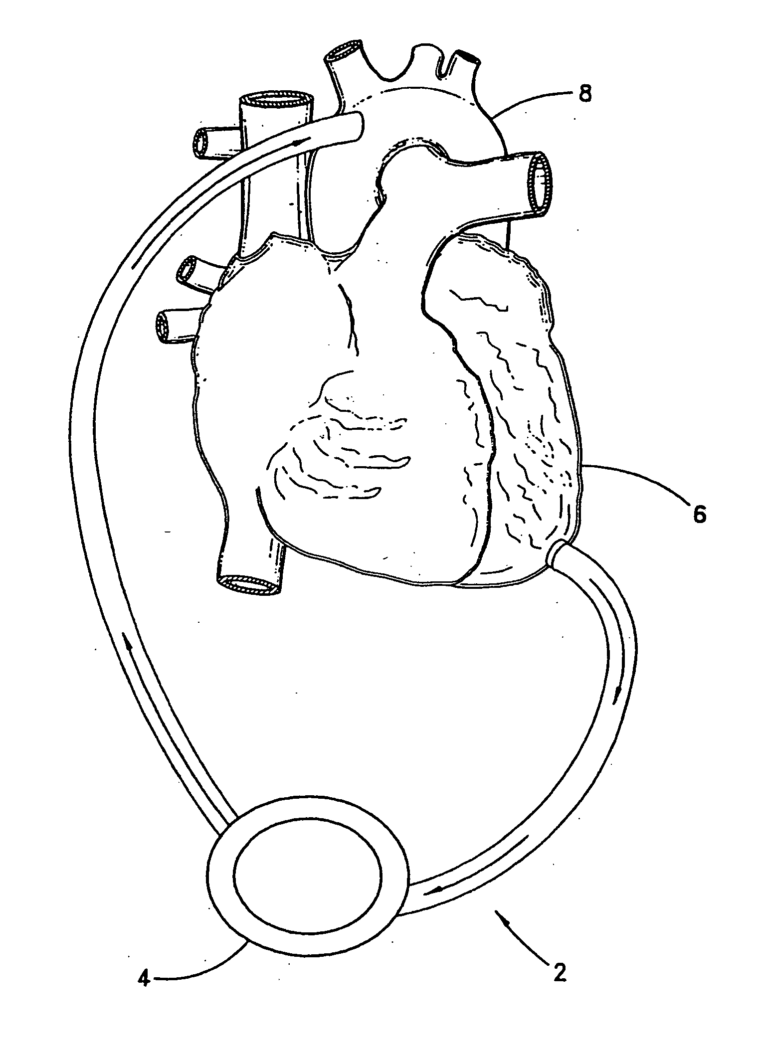 Implantable heart assist system and method of applying same