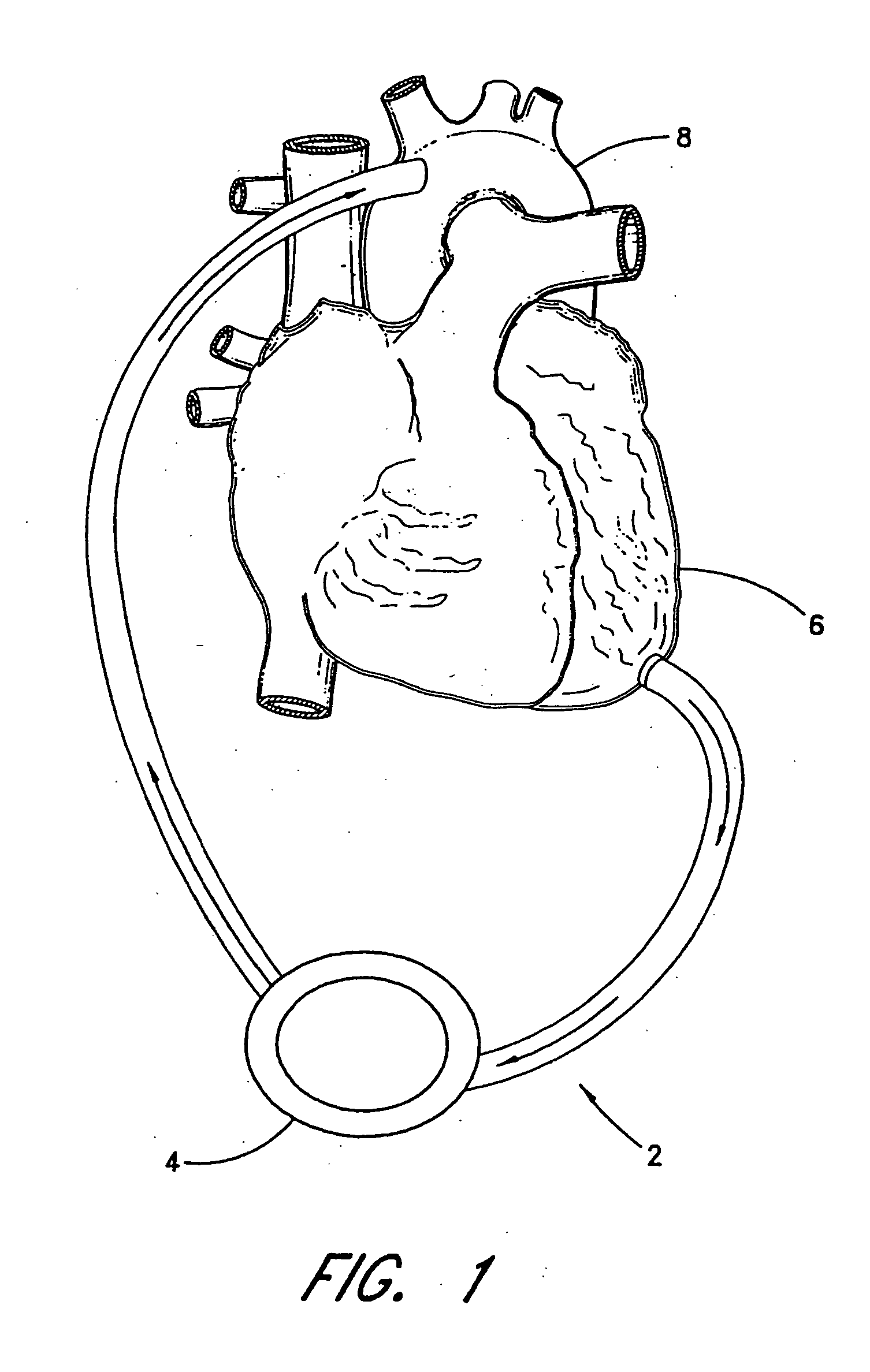 Implantable heart assist system and method of applying same