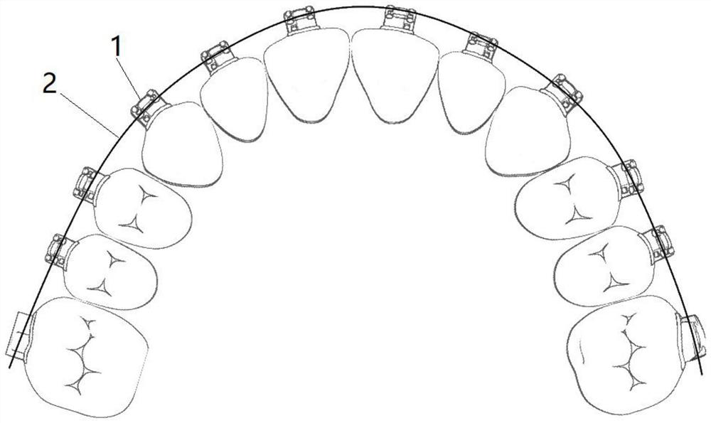 Method for correcting class II occlusion malformation