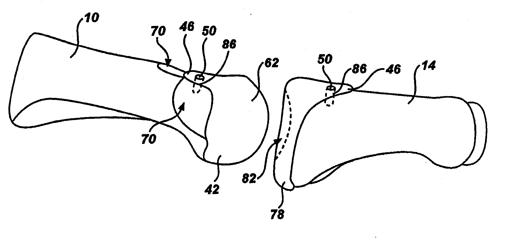 Artificial toe joint