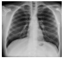 X-ray Image Classification Method and System for New Coronary Pneumonia Based on Lightweight Model