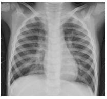 X-ray Image Classification Method and System for New Coronary Pneumonia Based on Lightweight Model