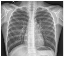 X-ray Image Classification Method and System for New Coronary Pneumonia Based on Lightweight Model