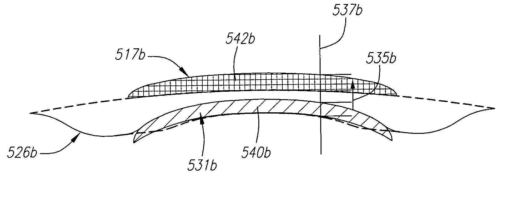 Intracorneal inlays