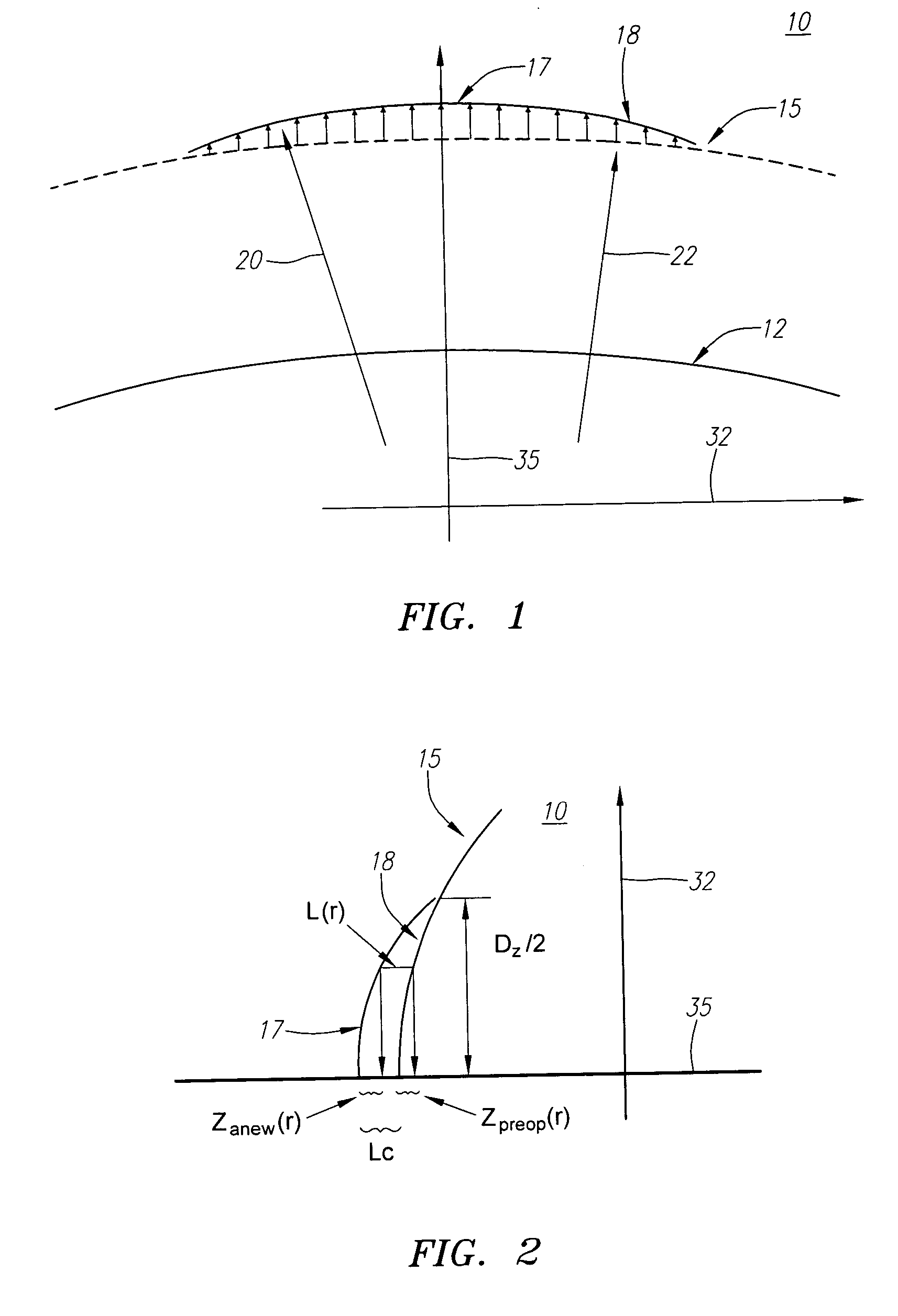 Intracorneal inlays