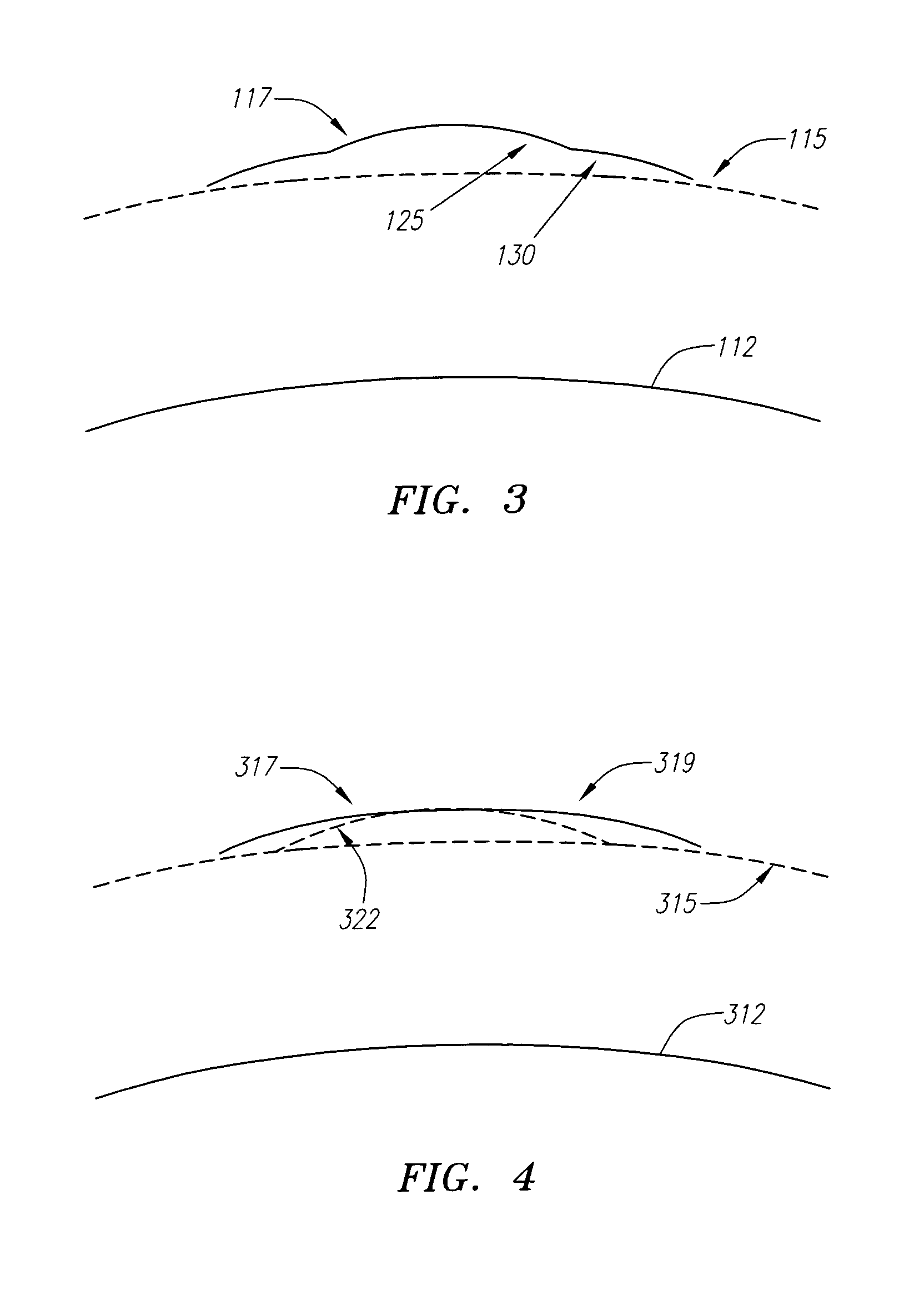 Intracorneal inlays