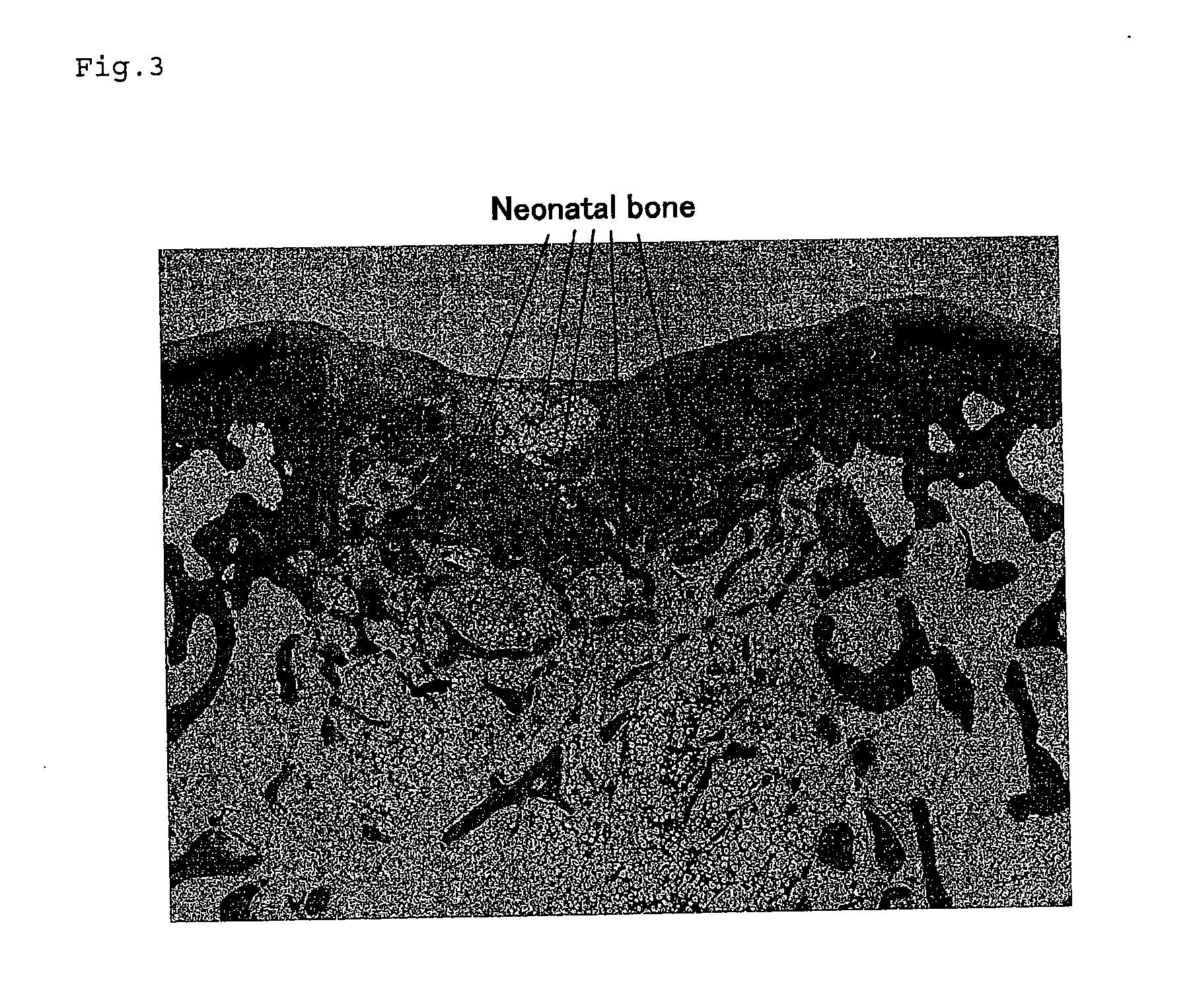 Bone-filling type agent for inducing cartilage regeneration