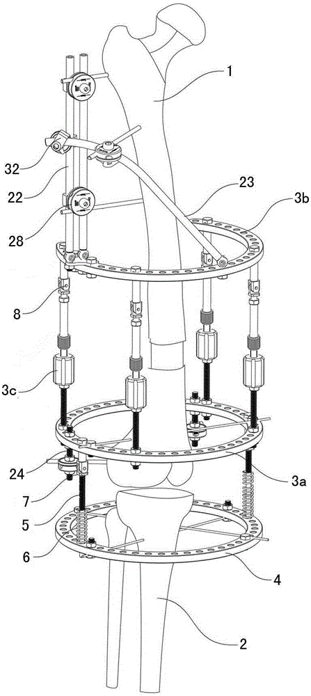 Femoral Ring Triangle Synchronous Control Extender