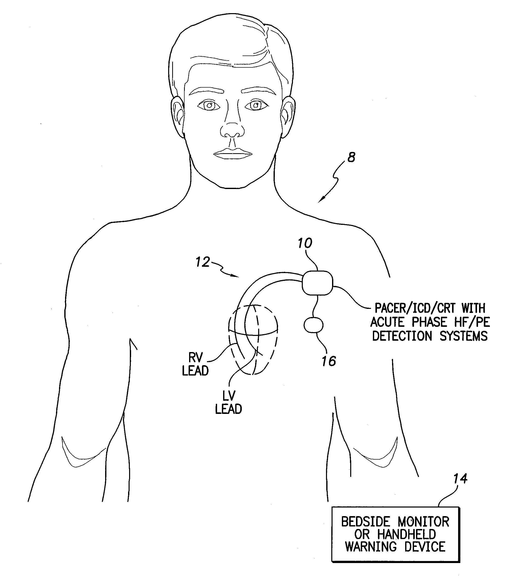 Systems and Methods for Activating and Controlling Impedance-Based Detection Systems of Implantable Medical Devices