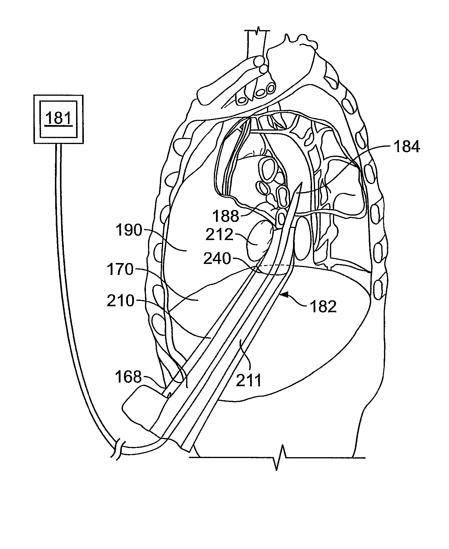 Diaphragm entry for posterior surgical access