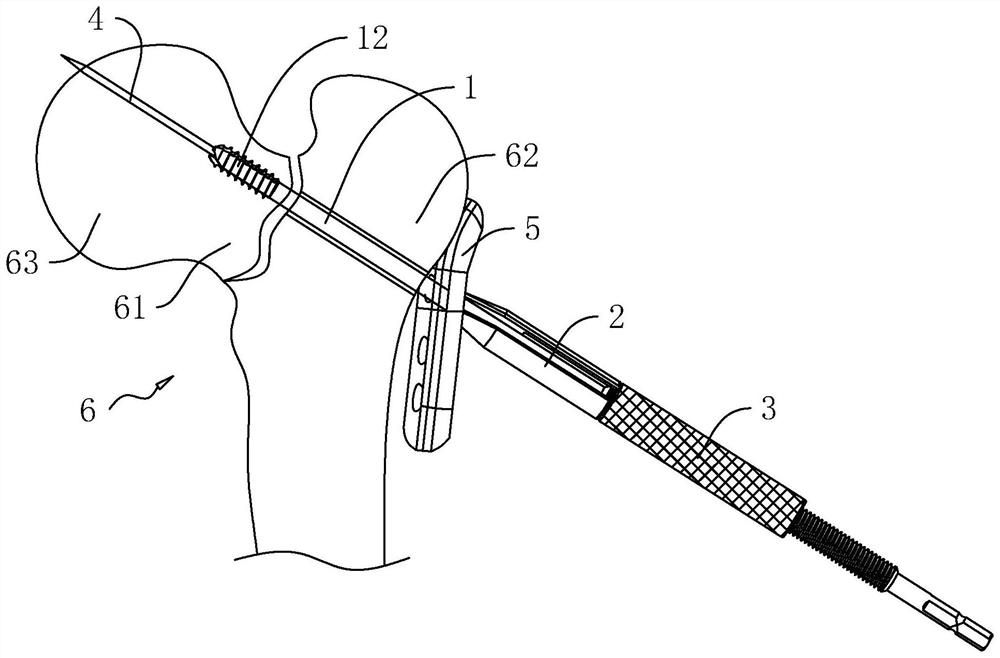 Femoral neck fracture reduction pressurizer