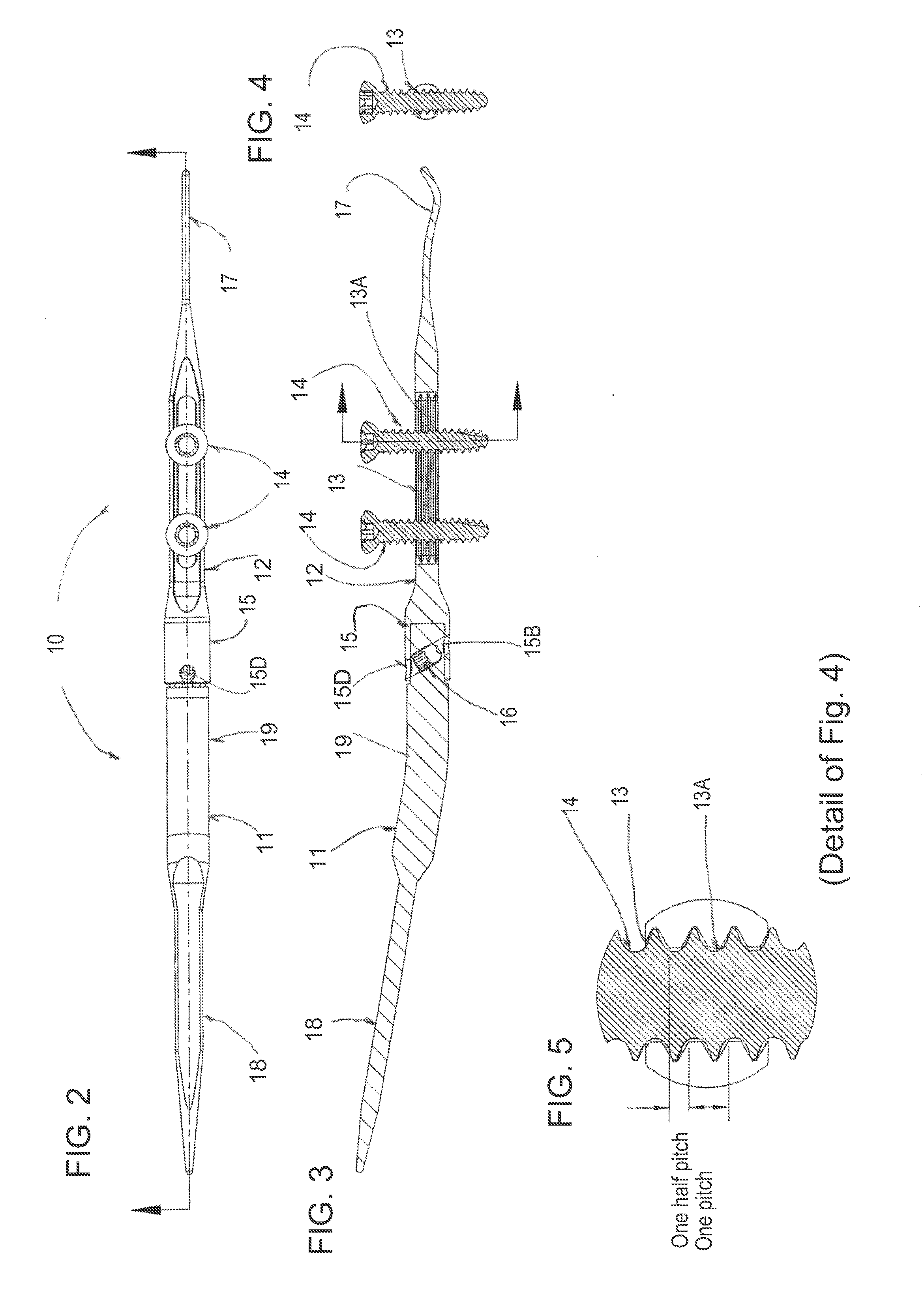 Intramedullary arthrodesis nail and method of use