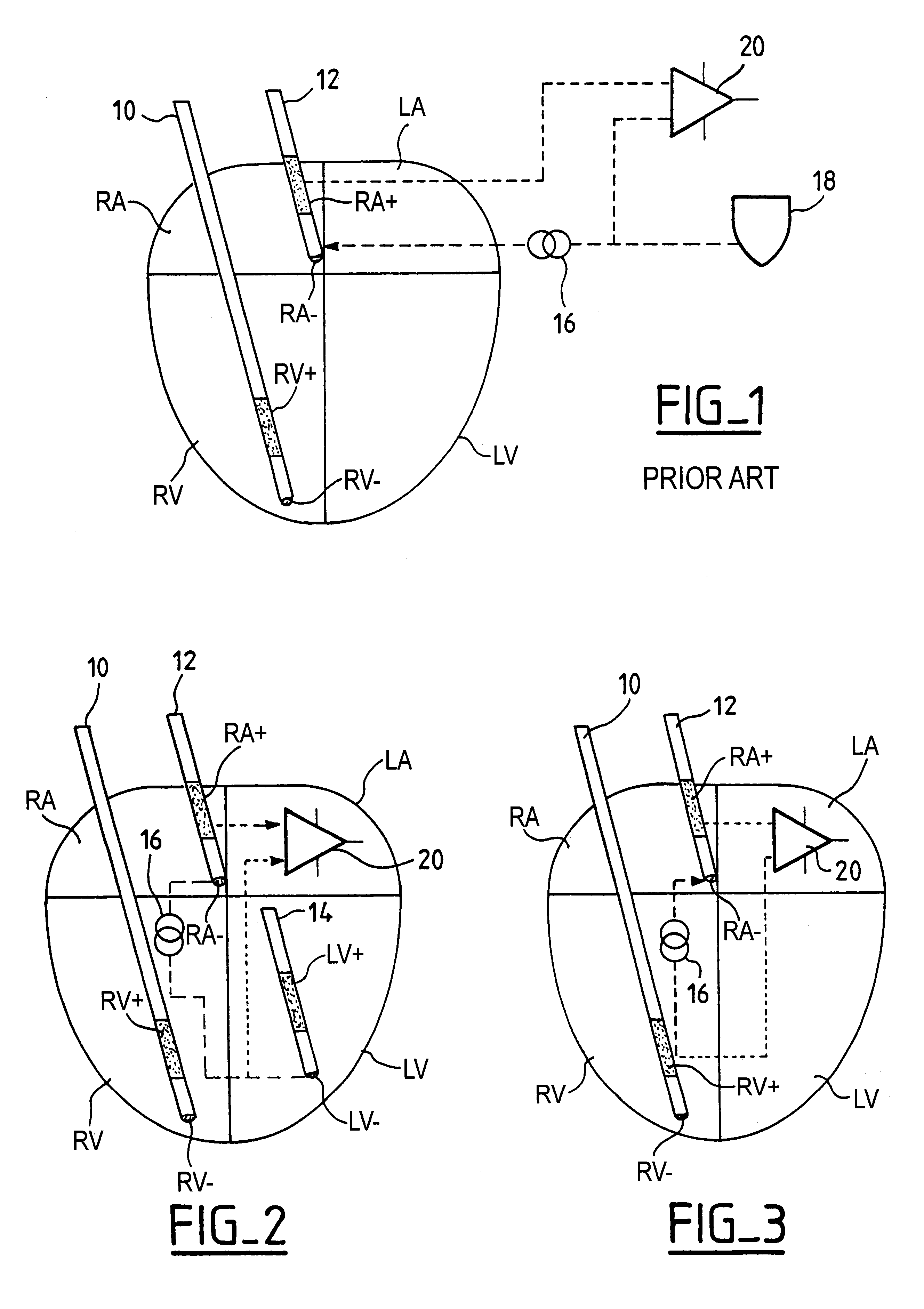 Measurement of intracardiac impedance in a multisite-type, active implantable medical device, in particular a pacemaker, defibrillator and/or cardiovertor