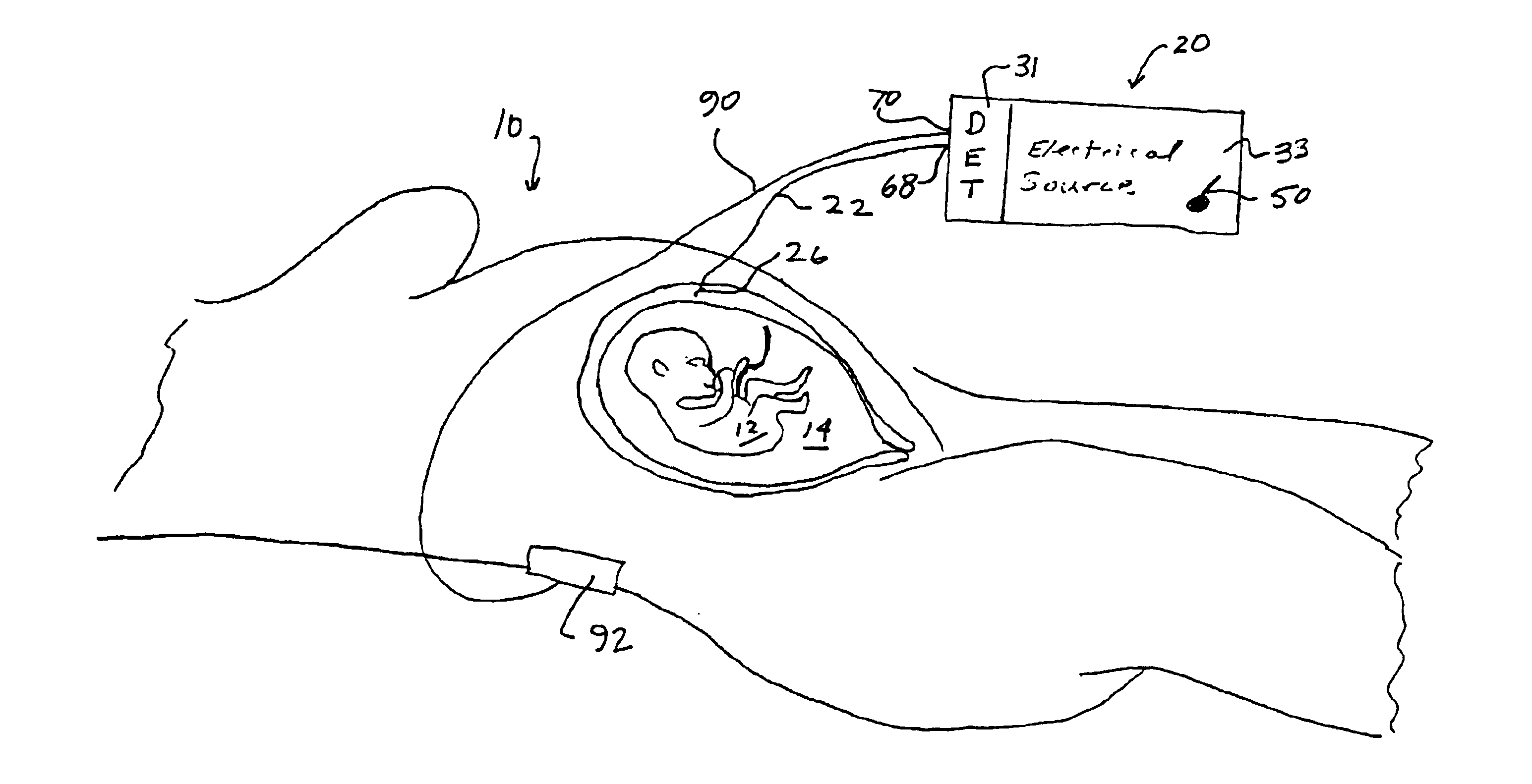 Uterine contraction detection and initiation system and method