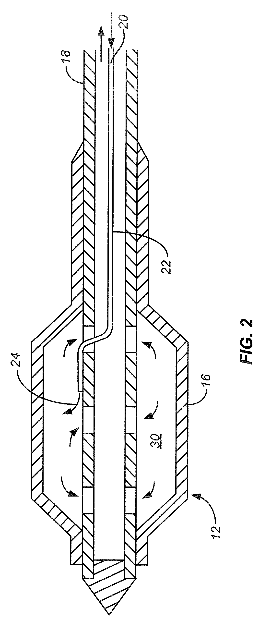 Barrett's Esophagus Cryogenic Ablation System