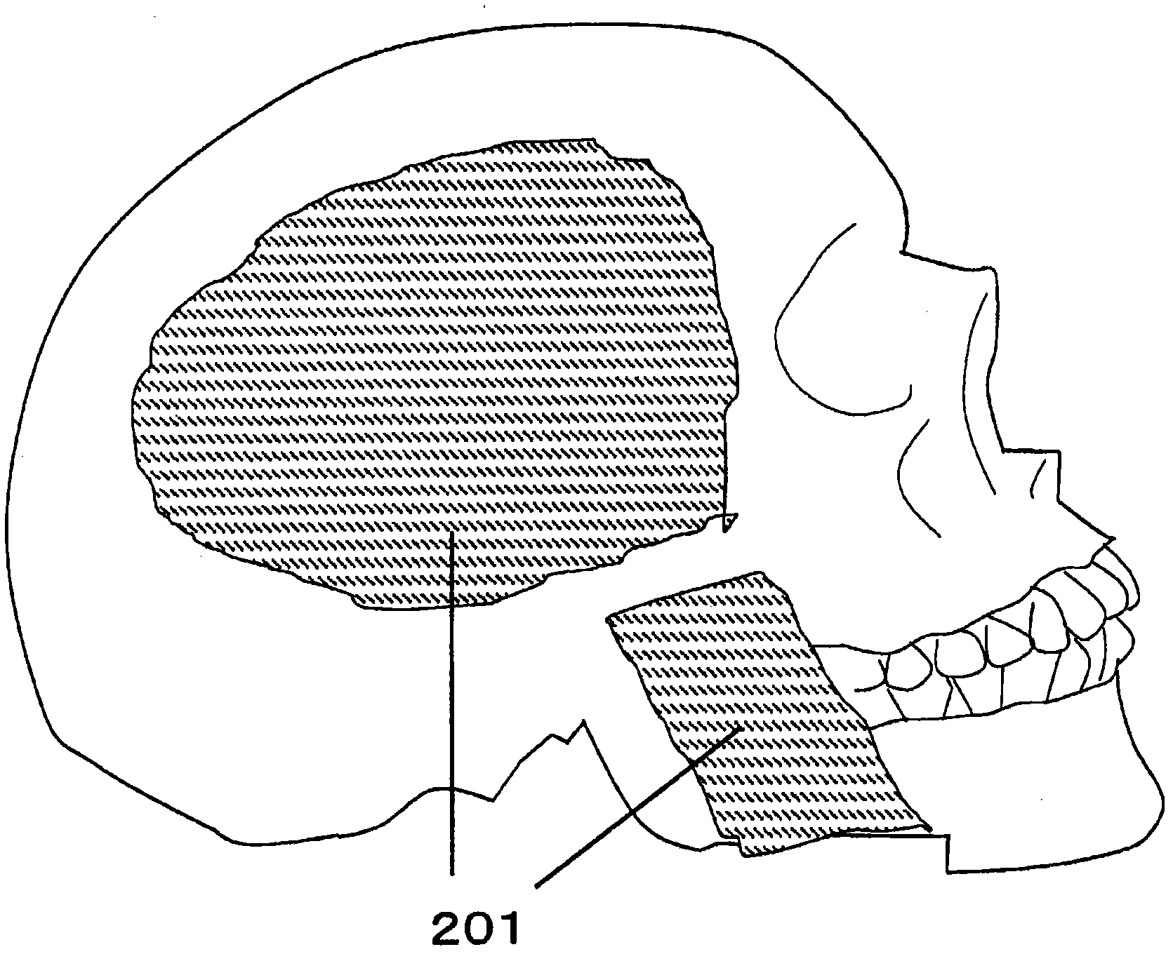 Interface system using mastication myoelectricity