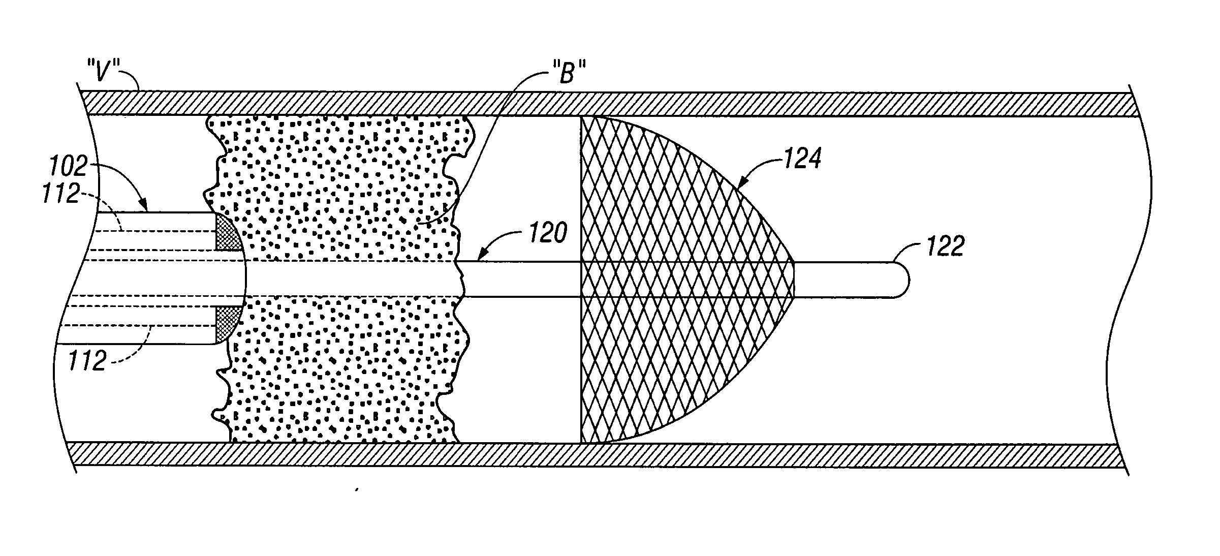 Percutaneous or surgical radiofrequency intravascular thrombectomy catheter system and method