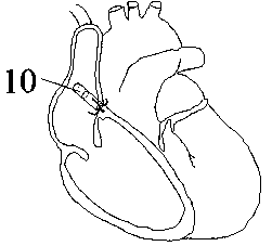 Multi-electrode pace-making modulatable wireless cardiac pacemaker system and manufacturing method