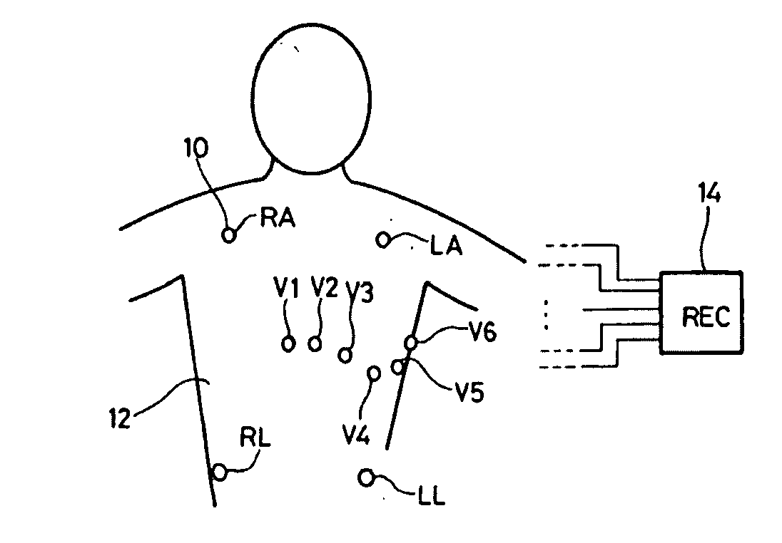 Electrocardiologic device for assisted diagnosis for the diagnostic of brugada syndrome or  early repolarization syndrome