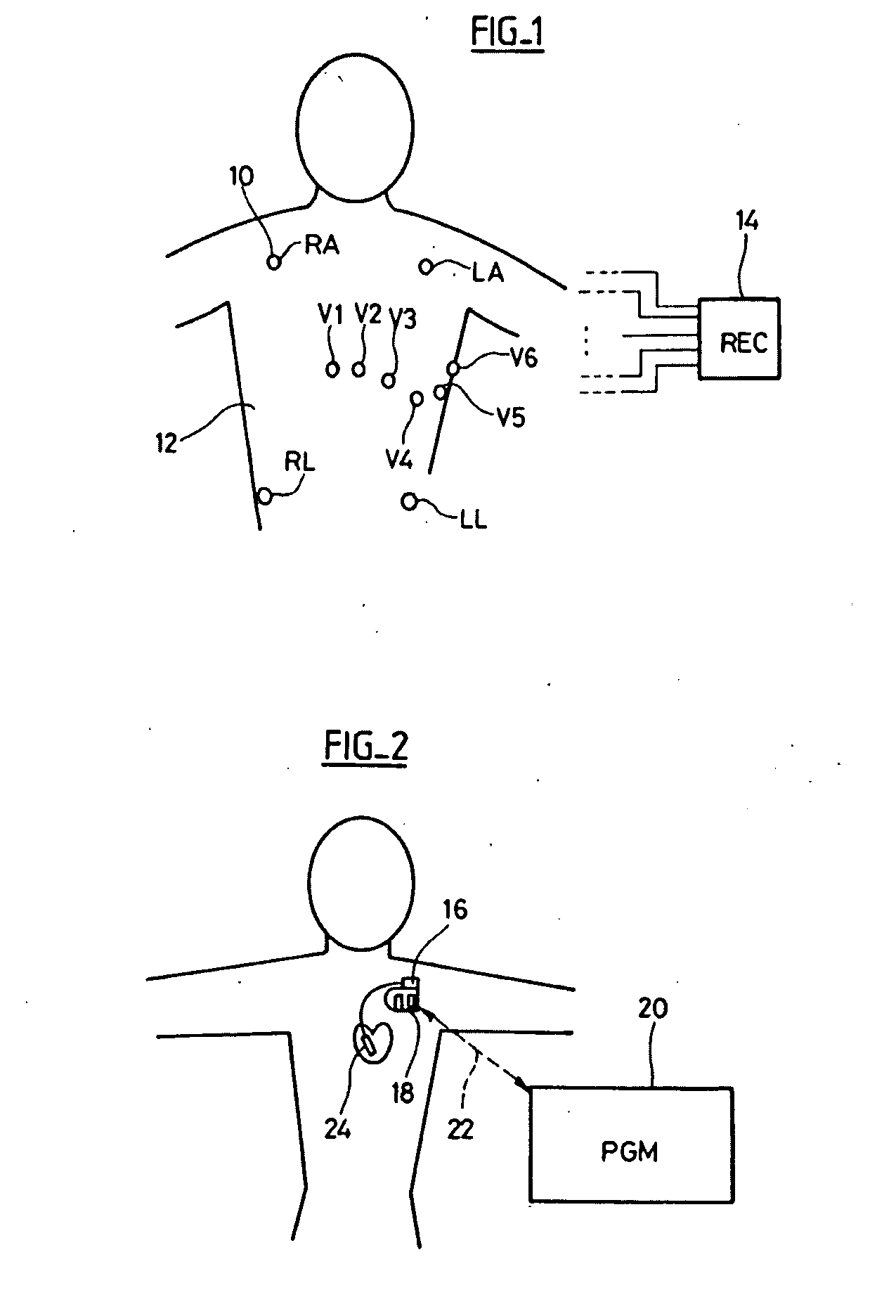 Electrocardiologic device for assisted diagnosis for the diagnostic of brugada syndrome or  early repolarization syndrome