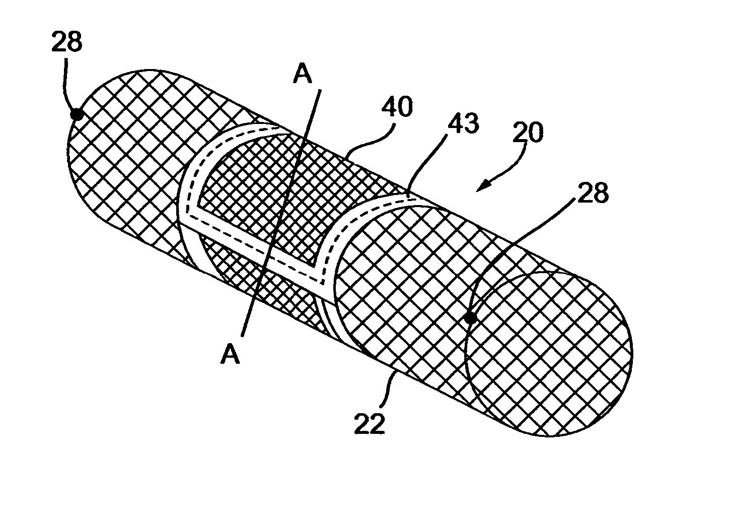 Implantable composite device and corresponding method for deflecting embolic material in blood flowing at an arterial bifurcation