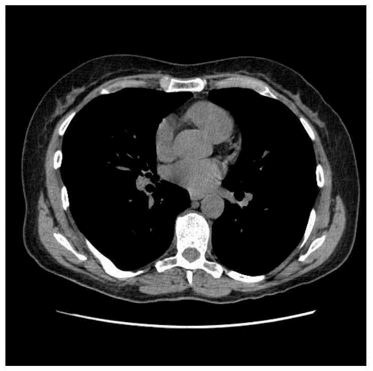 Lung segmentation method