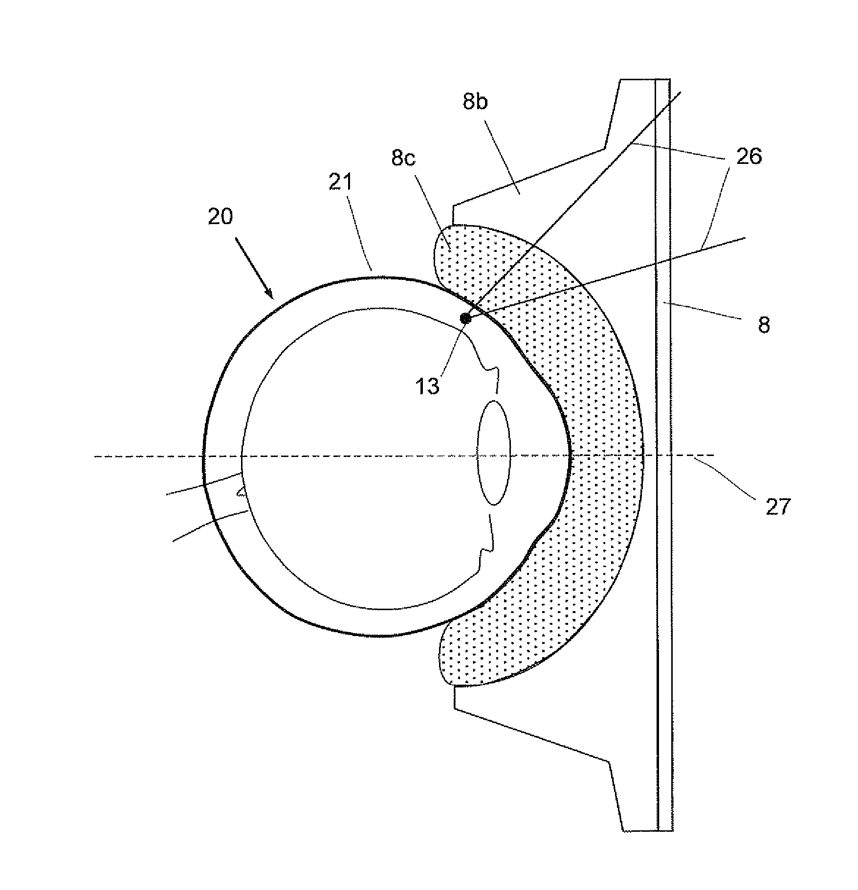 Laser therapy system for noninvasive correction of the refractive system of the eye