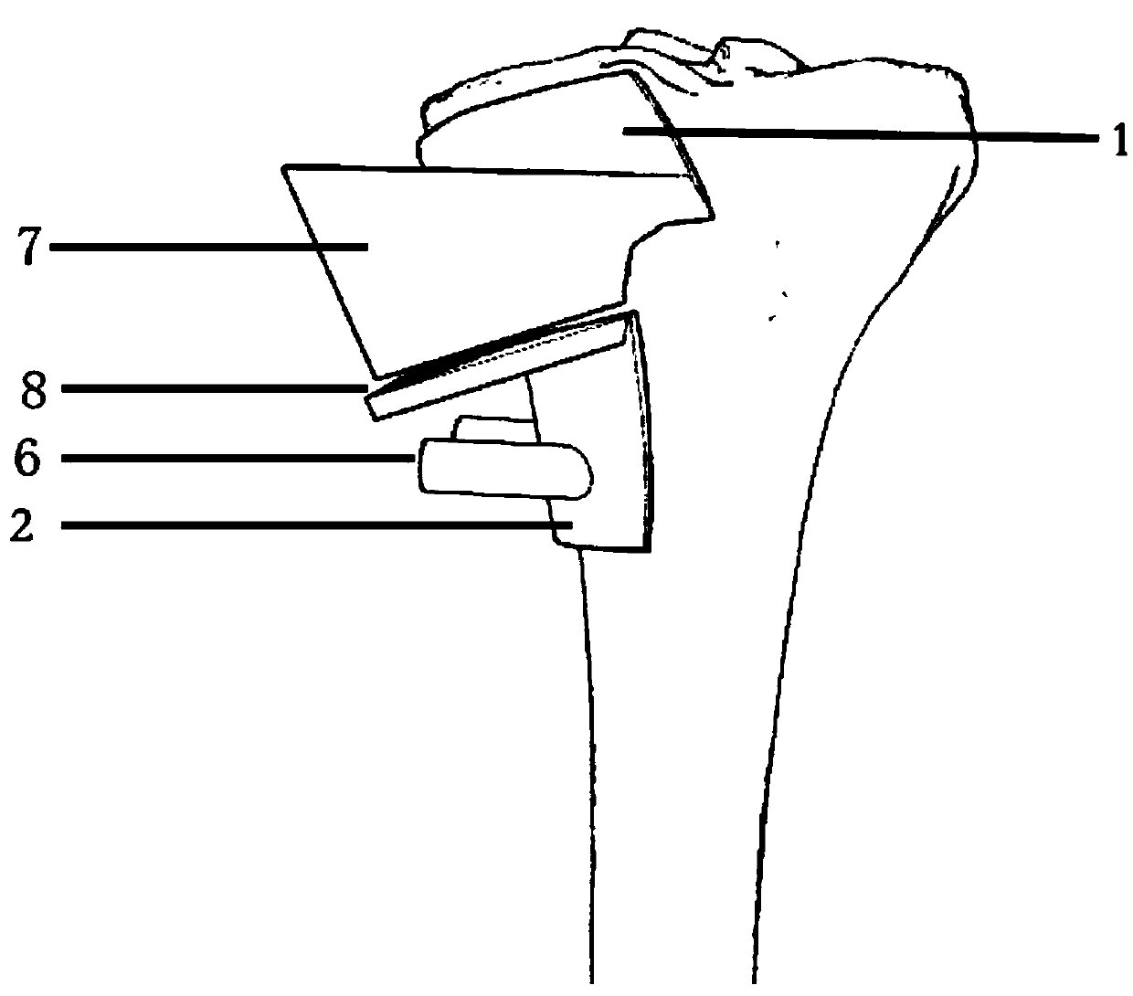 Preparation method of individualized 3D printed high tibial osteotomy guide plate