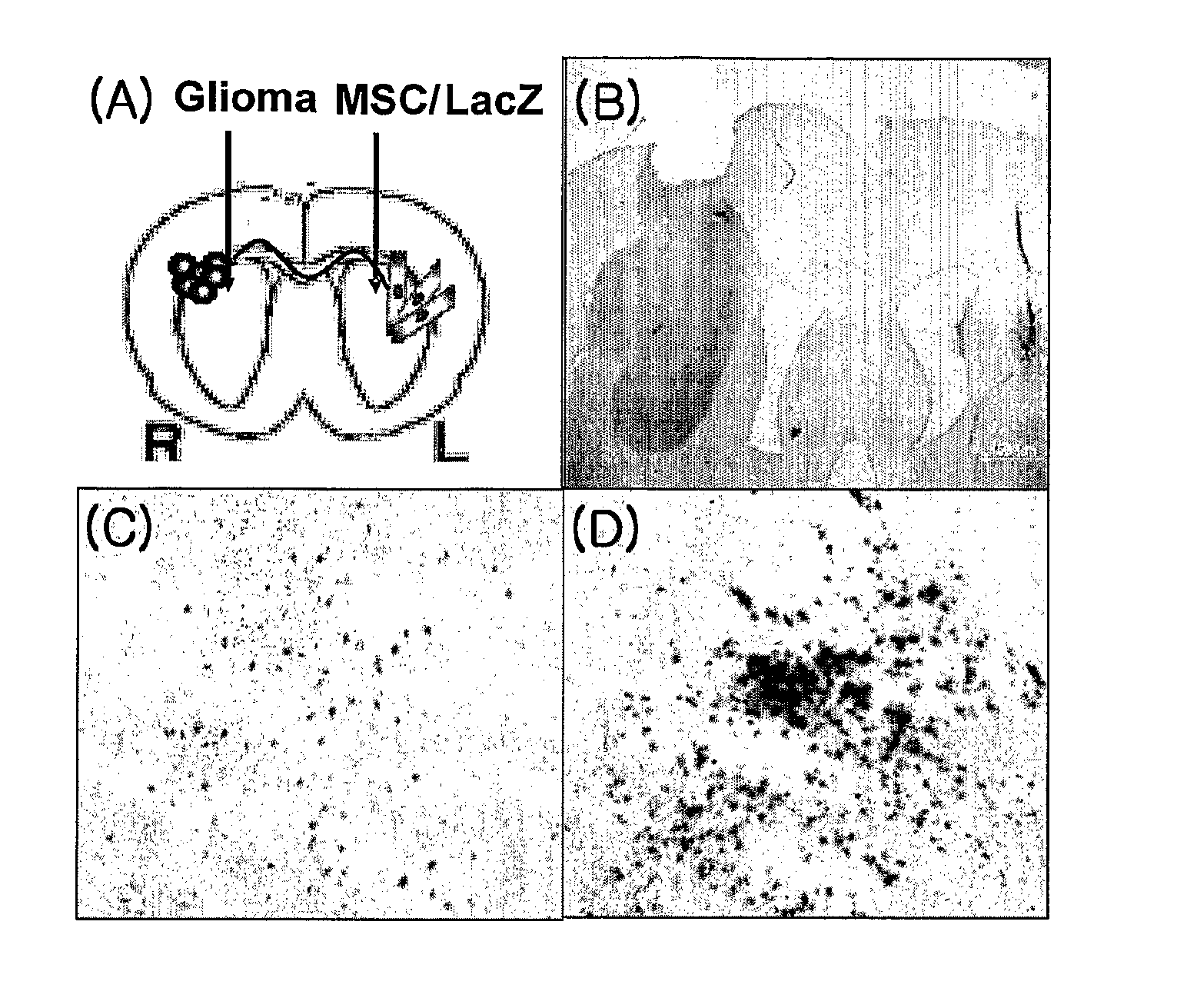 Use Of Mesenchymal Stem Cells Genetically Modified To Express A Suicide Gene For Treating A Cancer