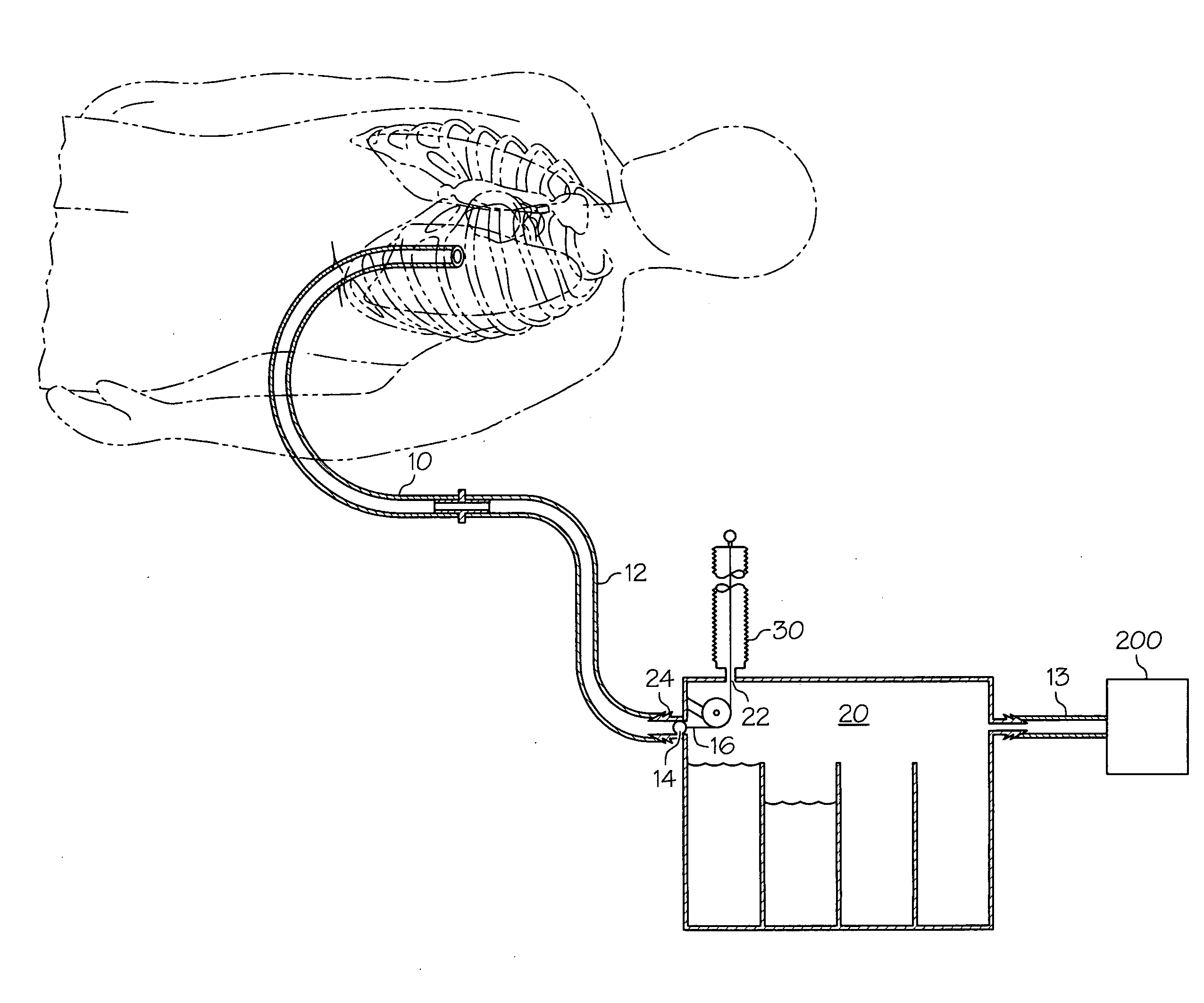 Methods and Devices to Clear Obstructions from Medical Tubes