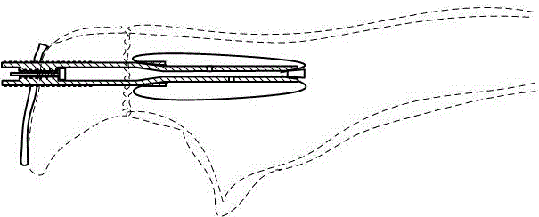 Olecranal fracture fixator