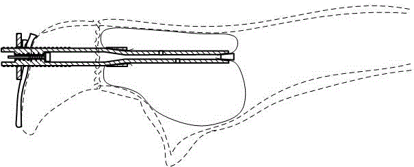 Olecranal fracture fixator