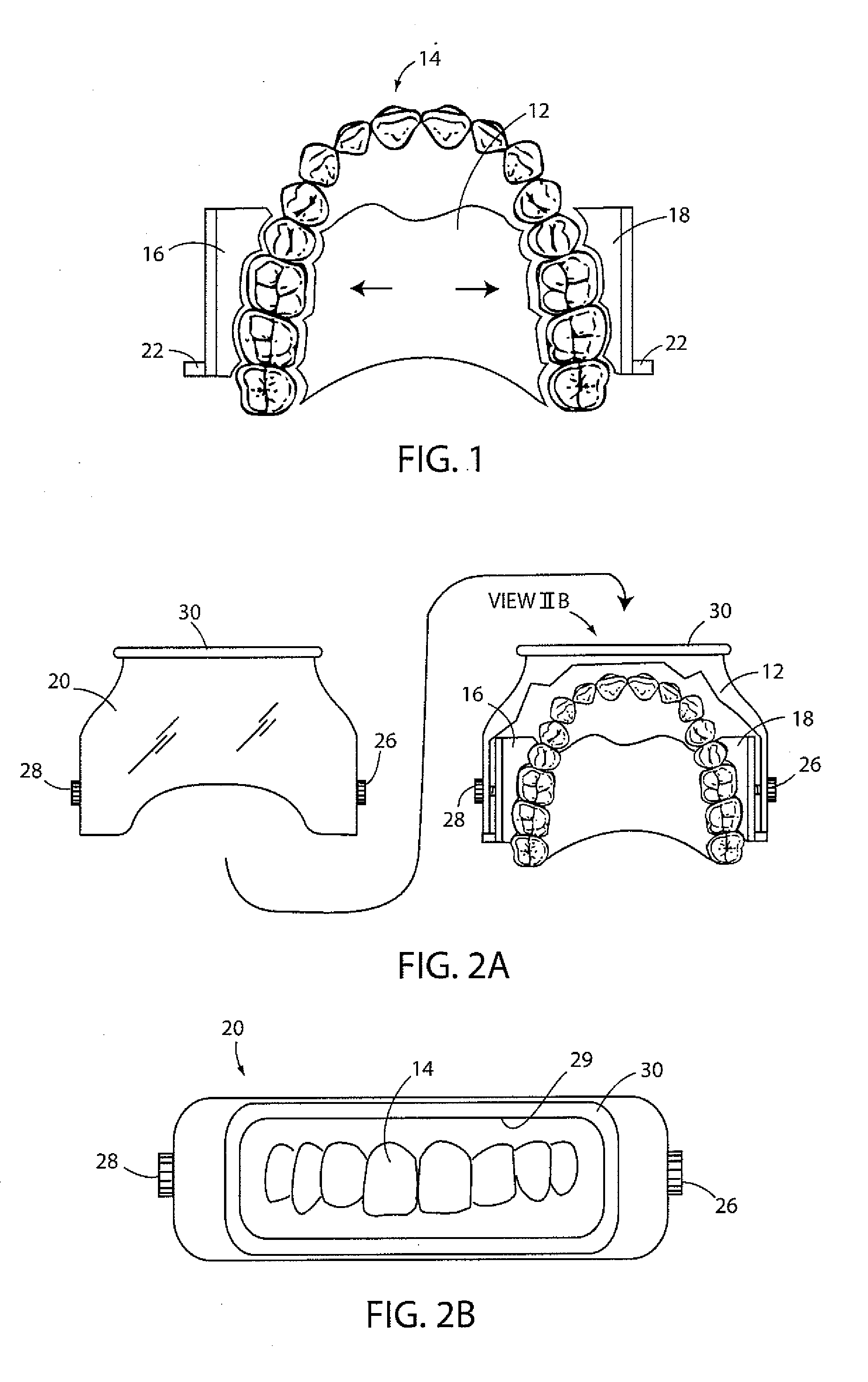 In-situ dental restoration process and apparatus