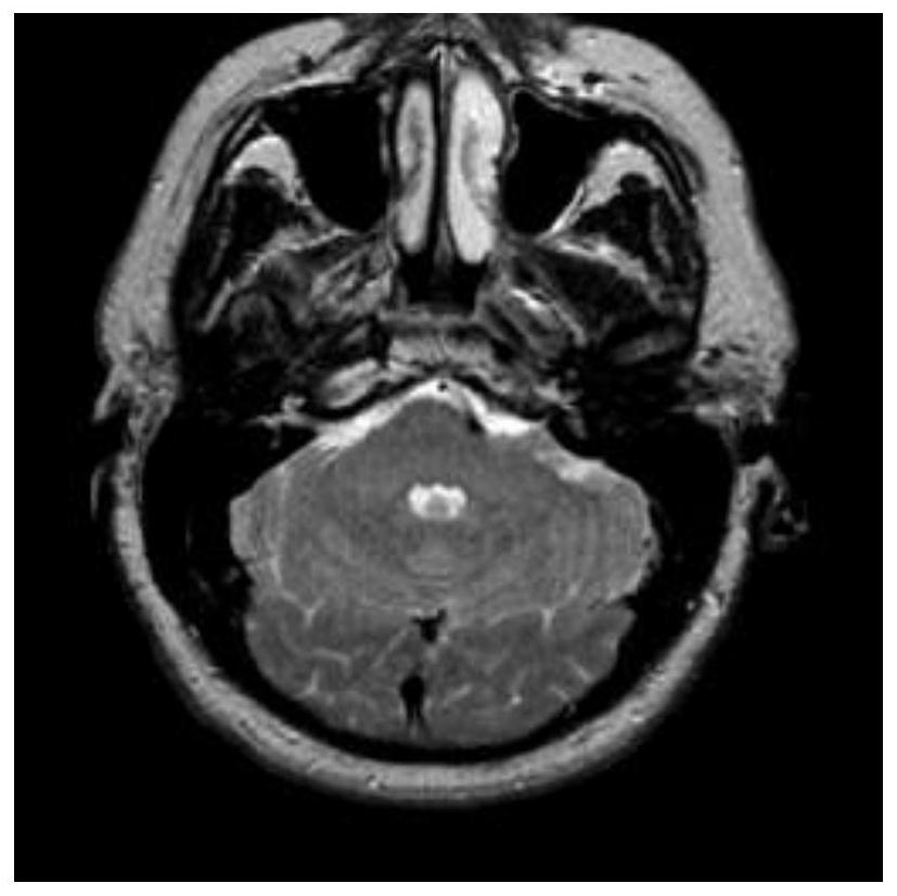 Medical image multi-threshold segmentation method based on interval iteration