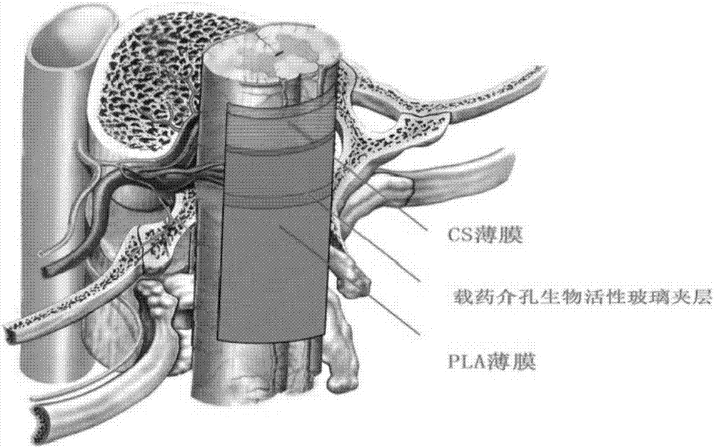 Making method of sandwich-type composite membrane stent