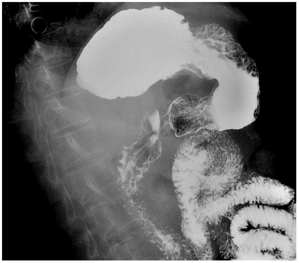 Digestive tract contrast agent having effect of treating gastrointestinal ulcer and good smearing effect