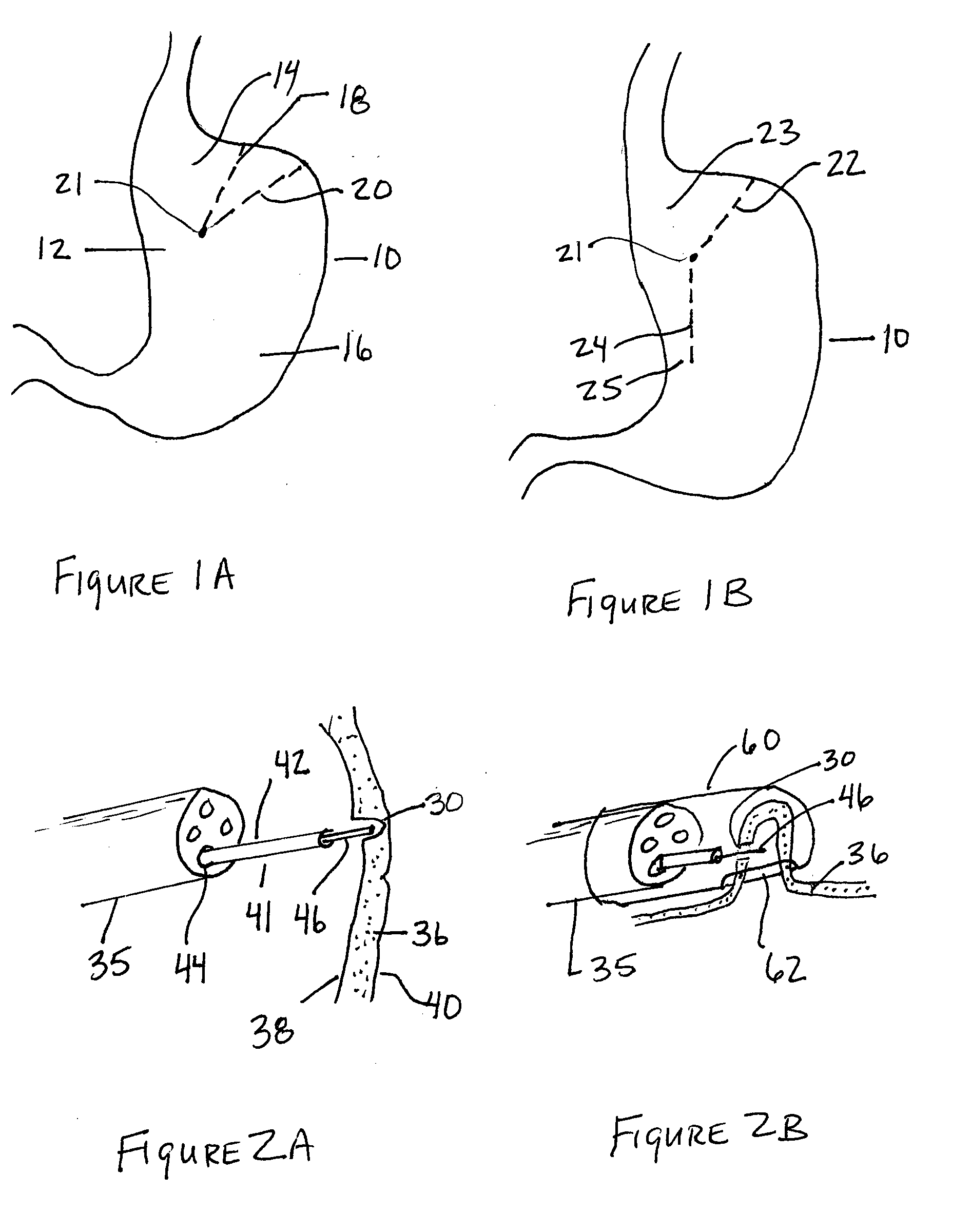 Methods and Devices for Organ Partitioning