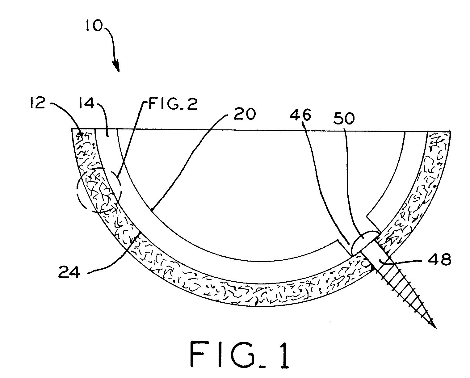 Orthopedic component of low stiffness