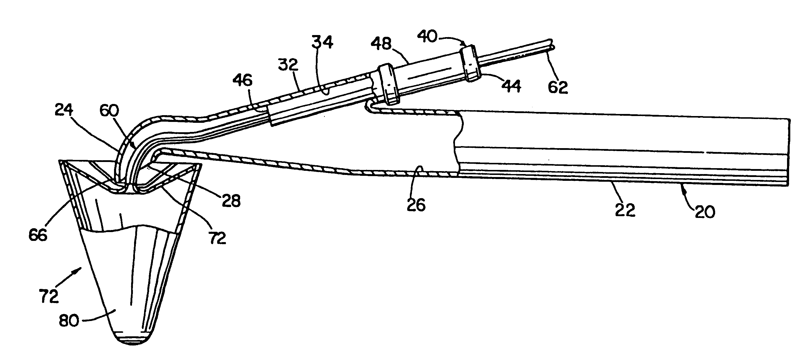 Methods for protecting a patient from embolic material during surgery