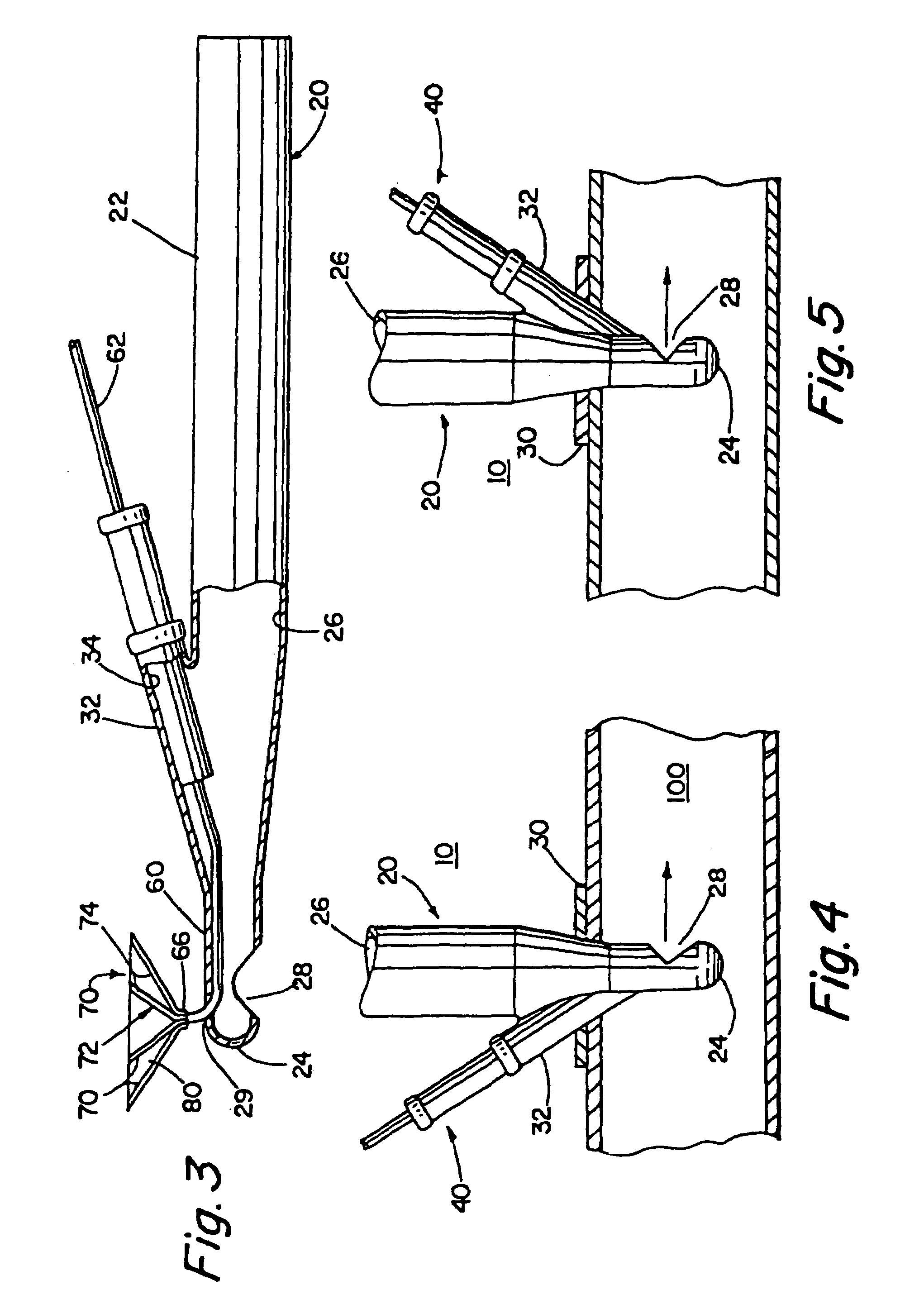 Methods for protecting a patient from embolic material during surgery