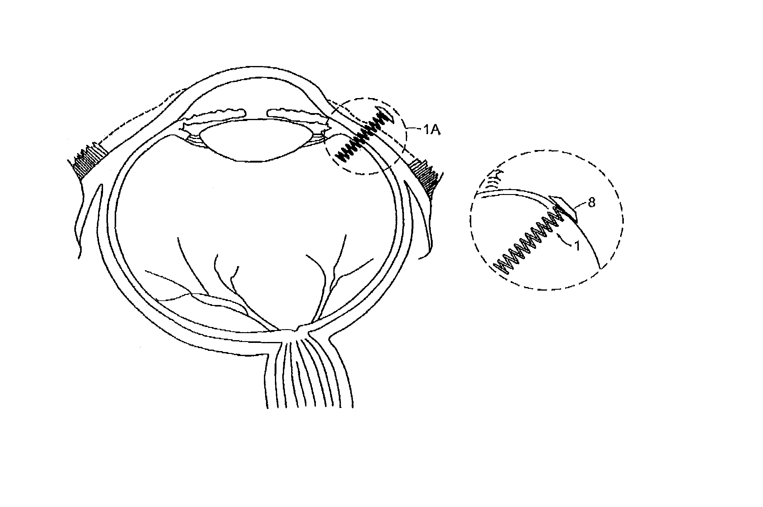 Devices for intraocular drug delivery