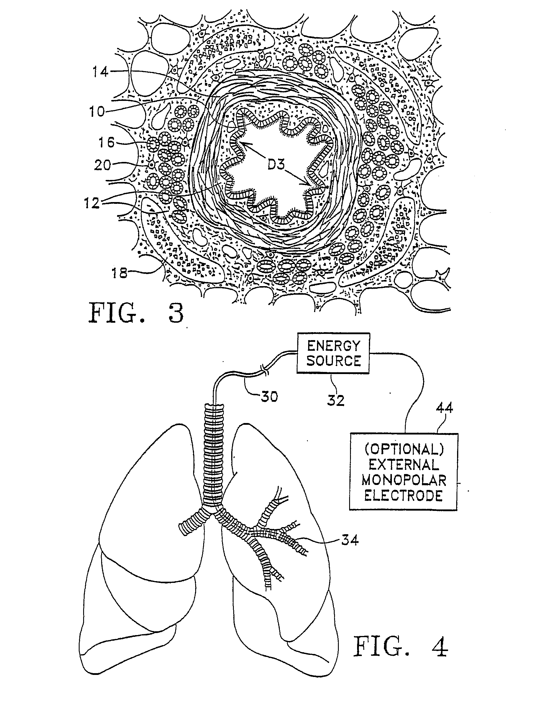 Modification of airways by application of energy