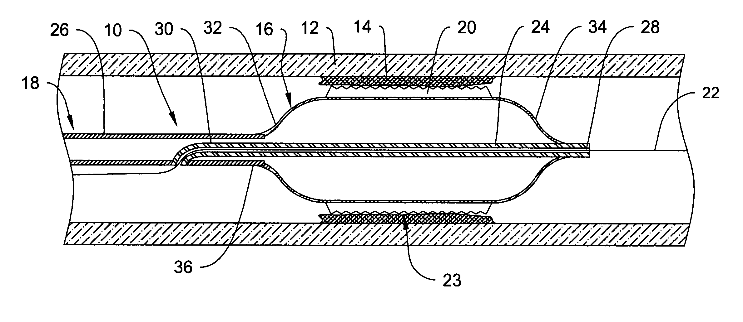 Traction cutting balloon